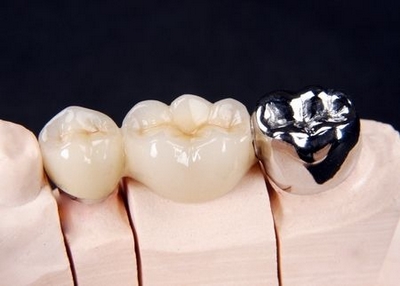 Alloy Grade 5 Medical Titanium Teeth